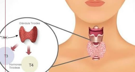 Hipotireoidismo – Tireoidite de Hashimoto