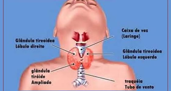 Hipotireoidismo Congênito